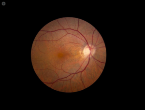 retinopatia