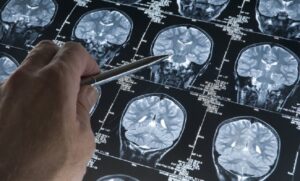 negligenza-motoria-lo-strano-caso-delluomo-diventato-mancino-dopo-un-tumore-al-cervello
