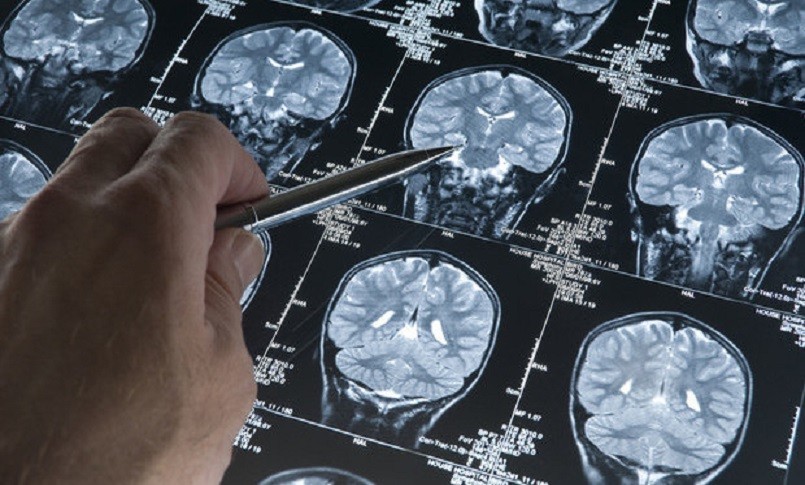 negligenza-motoria-lo-strano-caso-delluomo-diventato-mancino-dopo-un-tumore-al-cervello