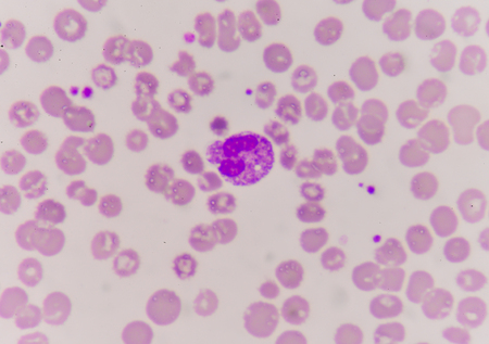 76534841-neutrofili-anormali-negli-strisci-di-sangue-sepsi-o-setticemia-sono-una-malattia-potenzialmente