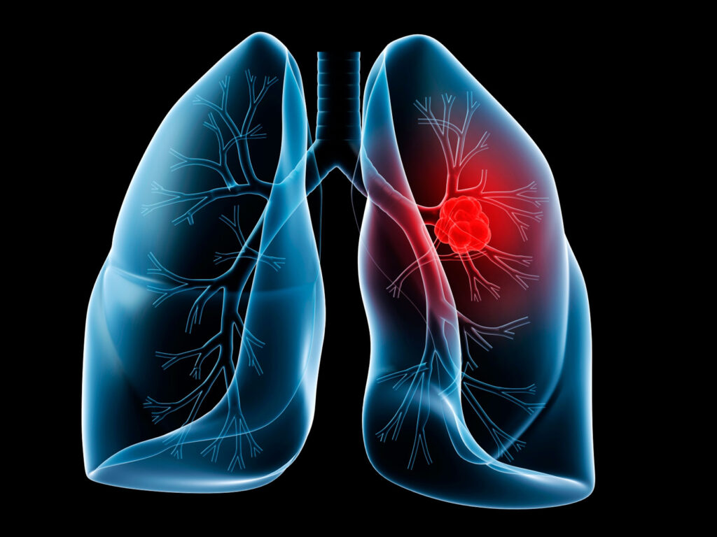 Tumori al polmone: mortalità in calo anche per le donne. Lo studio italiano